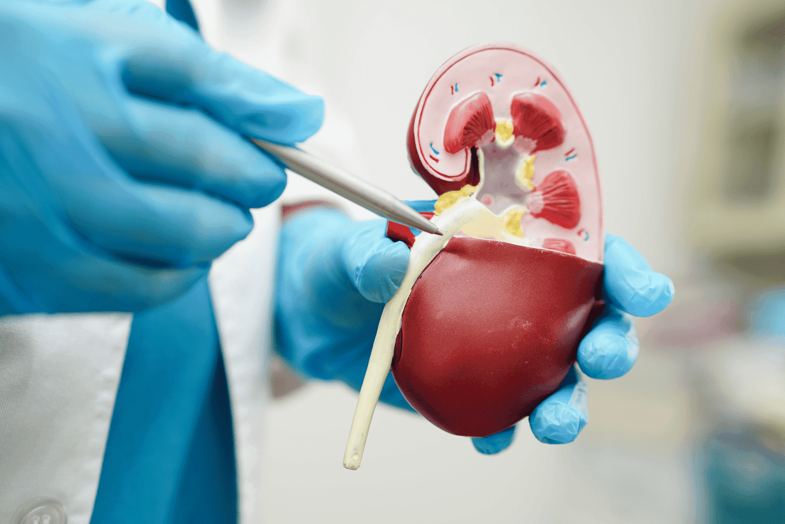 bpc 157 kidney stones New compound stops progressive disease in its tracks After Passing a Kidney Stone: