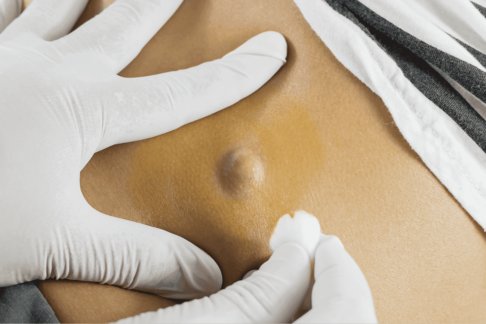 bpc 157 lump Found a on Your Back? Here's What It Might Be Buy BPC-157 | Pinnacle Peptides