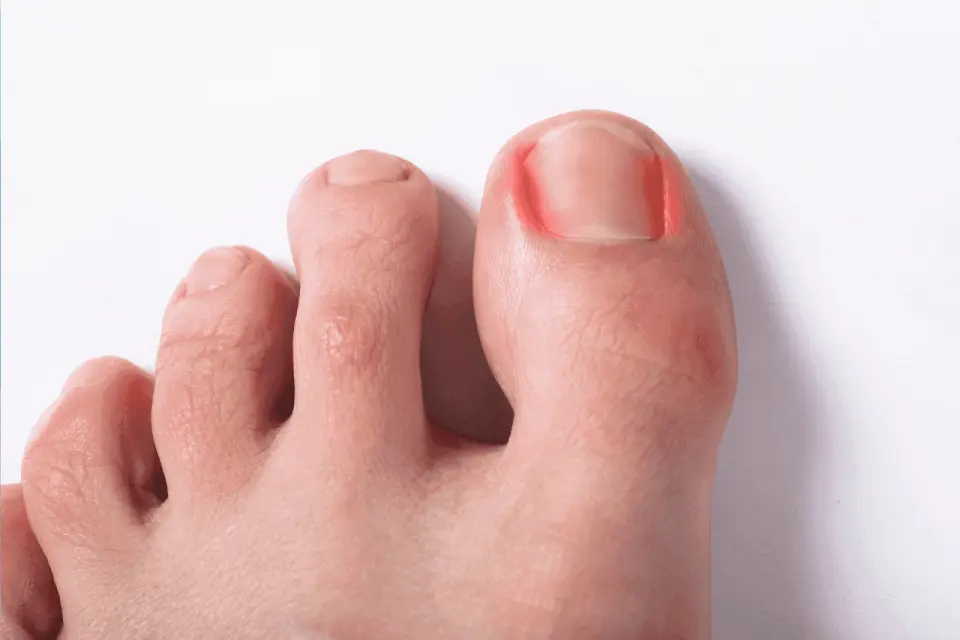 Why Are My Toes Turning Red?