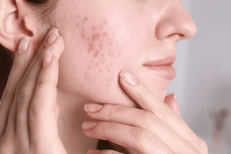 5 Common and Serious Side Effects of PanOxyl (2026)