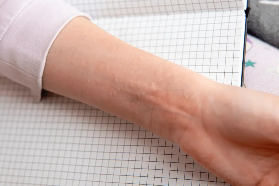 What Triggers Hives? 12 Common Causes You Might Not Expect