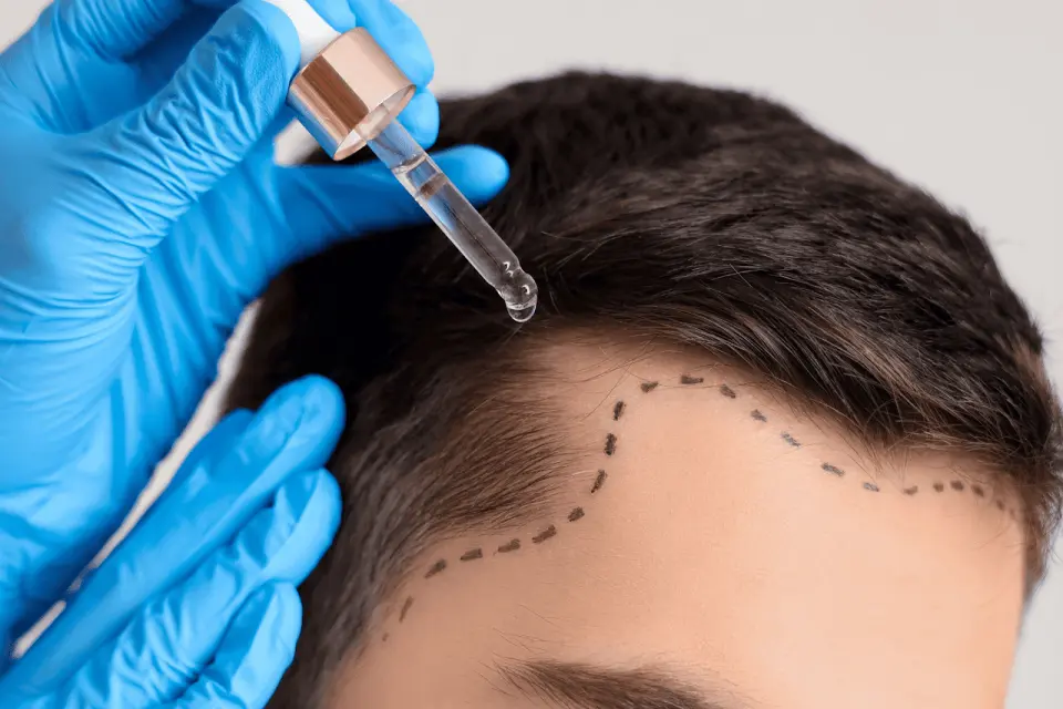Does Minoxidil (Rogaine) Actually Work?