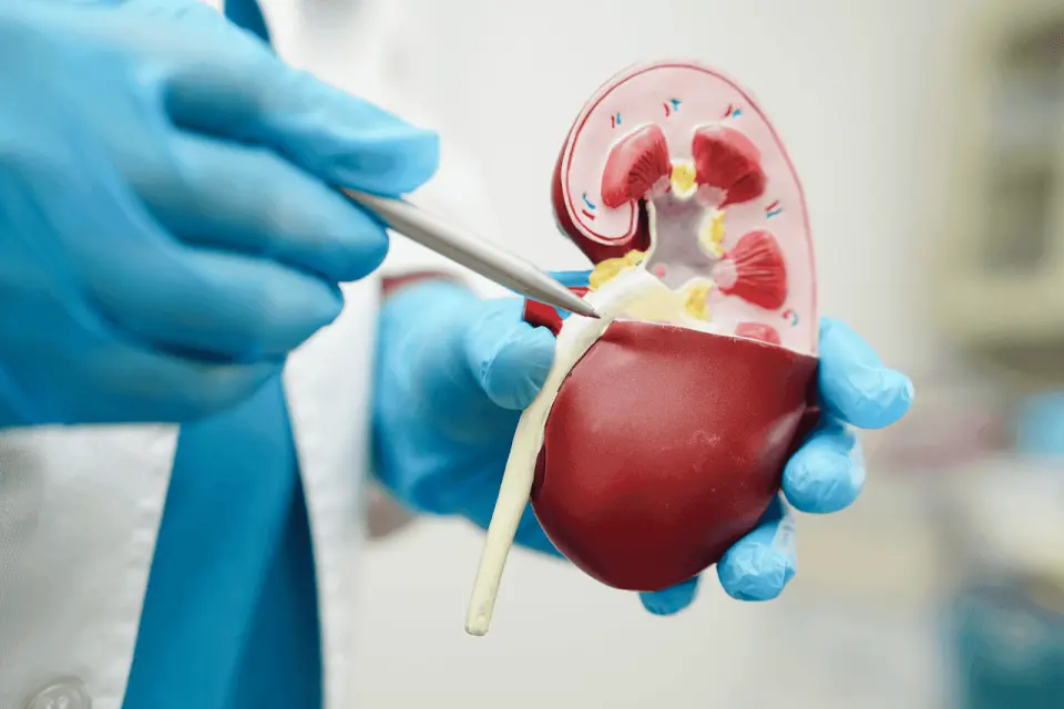 What to Expect After Passing a Kidney Stone