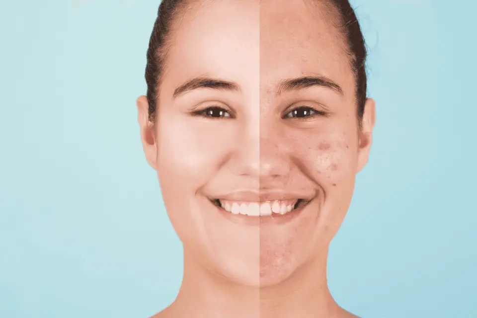 5 Common and Serious Side Effects of Cleocin-T