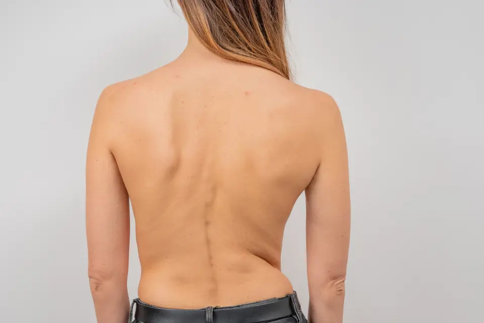 What Is Scoliosis of the Spine?