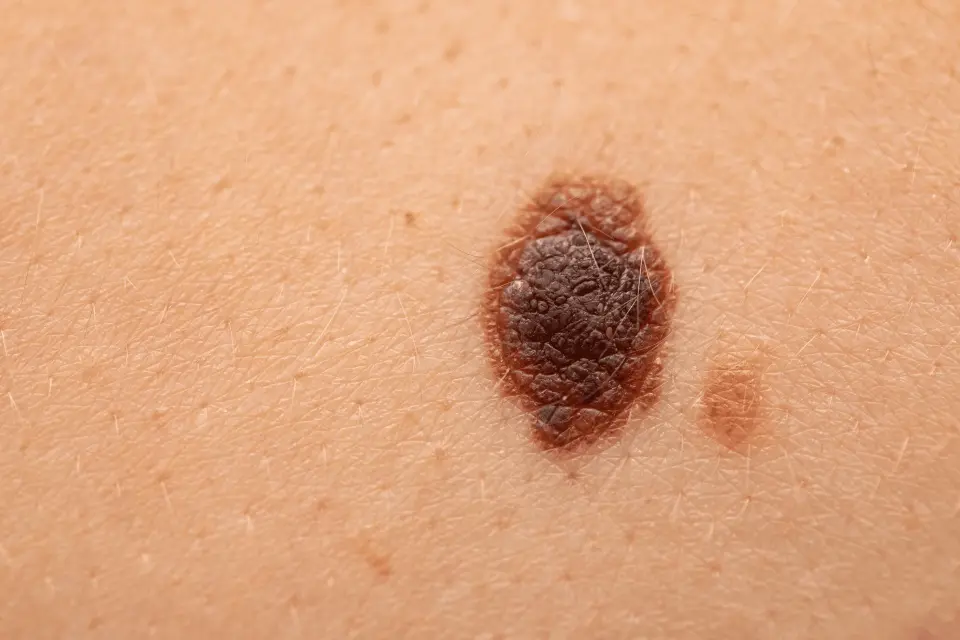 What Does Melanoma Actually Look Like? Dermatologists Explain