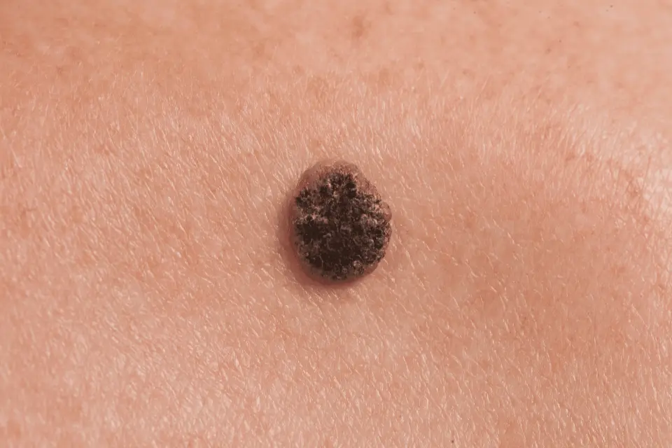 Squamous Cell Carcinoma: Early Signs, Risk Factors, and When to See a Doctor