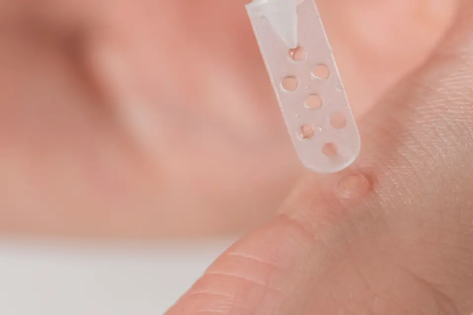 What Causes Warts on Hands and How to Prevent Them