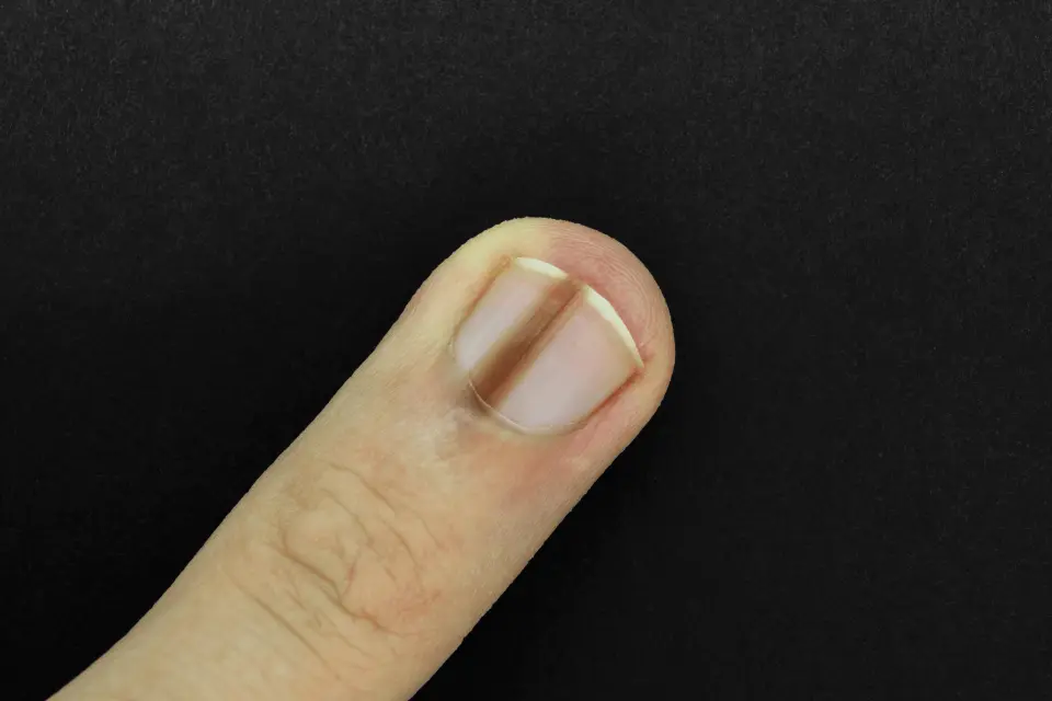 Dark Stripe in Your Toenail: Should You See a Dermatologist?