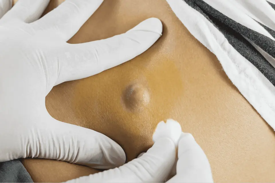 Found a Lump on Your Back? Here’s What It Might Be