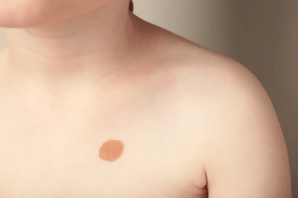 Moles vs. Birthmarks: What's Normal and What Warrants a Check