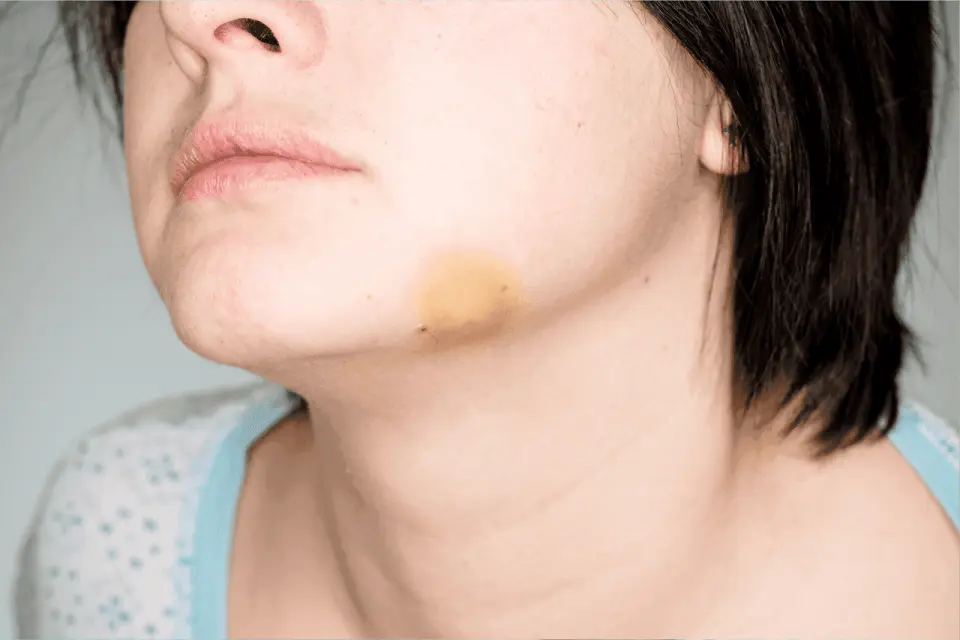 Got a Bruise on Your Chin? Here's When to Pay Attention