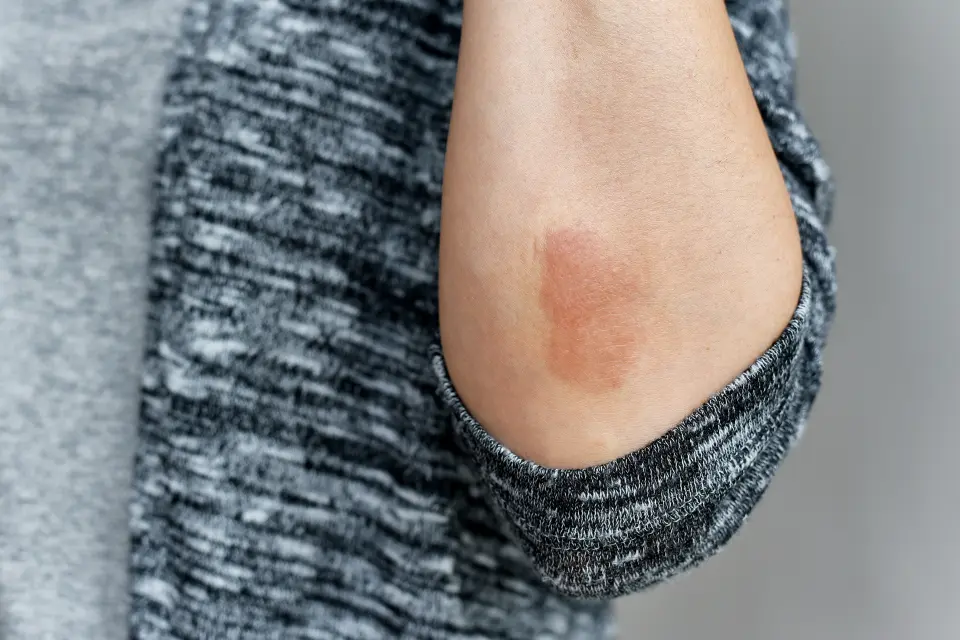 What Triggers Eczema? Common Flare-Ups Including Sun and Seasonal Changes