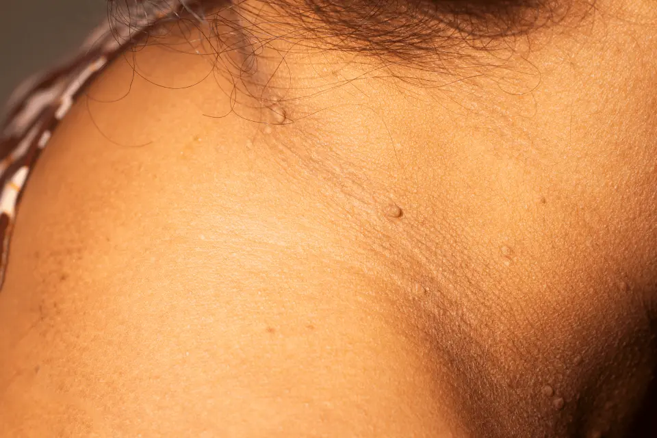 What Causes Skin Tags? Risk Factors and Prevention Tips