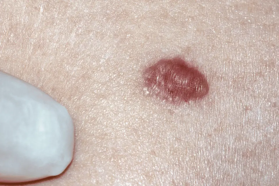 Basal Cell Carcinoma: The Most Common Skin Cancer Explained