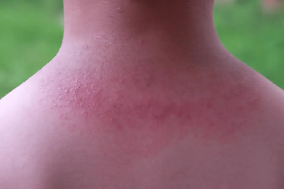Heat Rash: What It Looks Like, What Causes It, and How to Treat It