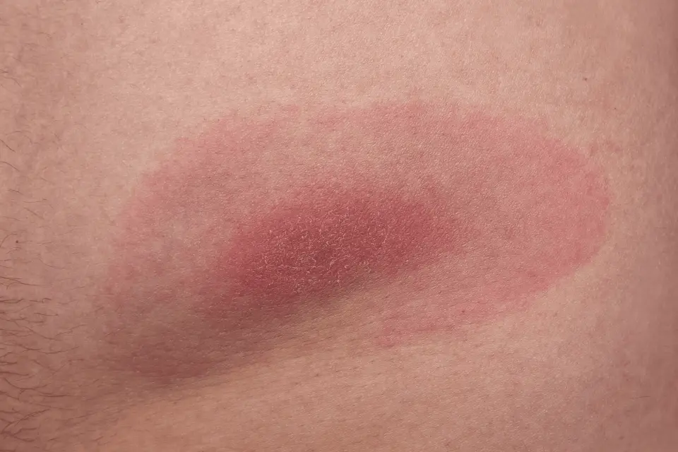 tirzepatide skin sensitivity reddit Injection Site Reaction Treatment: Evidence-Based Management Guide 5 Common and Serious Side