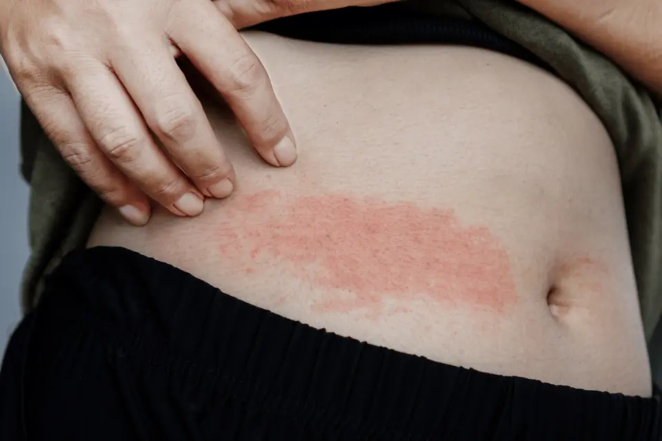 Rash on Your Stomach: Common Causes and When to Get It Checked