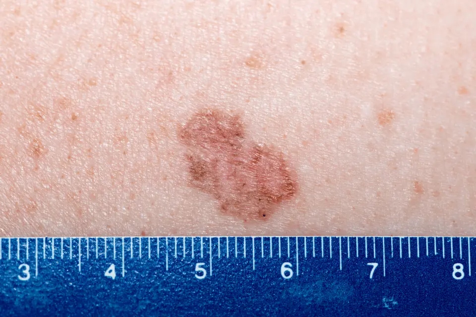 Basal Cell Carcinoma: Identifying the Most Common Skin Cancer