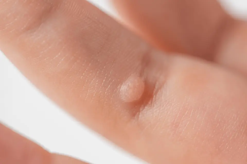 Urgent Care Wart Removal: What to Expect