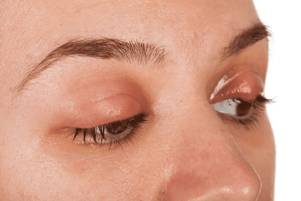 Puffy or Swollen Eyelid? Here's What It Could Mean