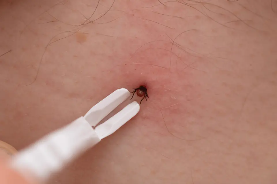 Lyme Disease Rash: What the Bullseye Pattern Really Looks Like