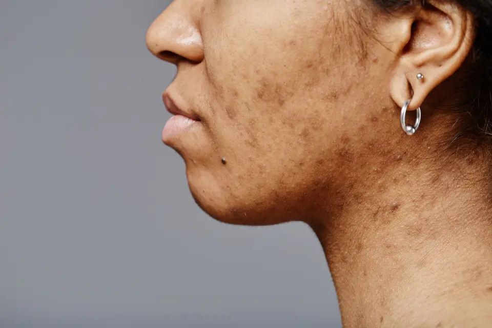 How Long Does Menopause Acne Last?