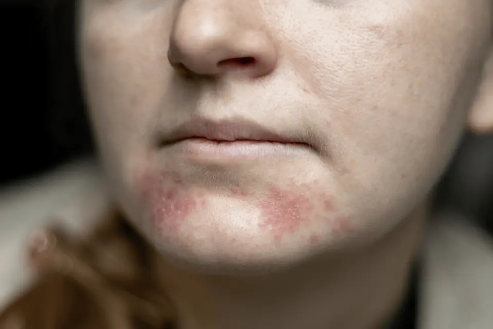 Perioral Dermatitis Treatment: How to Clear Up This Stubborn Facial Rash