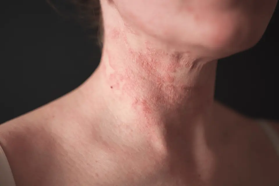 What Does Eczema Look Like? Identifying It Across Different Skin Tones
