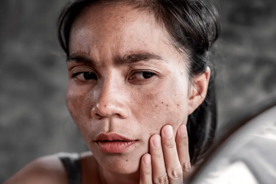 Brown Spot on Your Skin: Sun Damage, Age Spot, or Something Else?