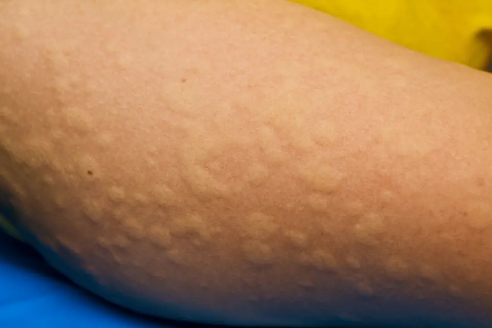 Cold Urticaria: When Cold Weather Causes Hives