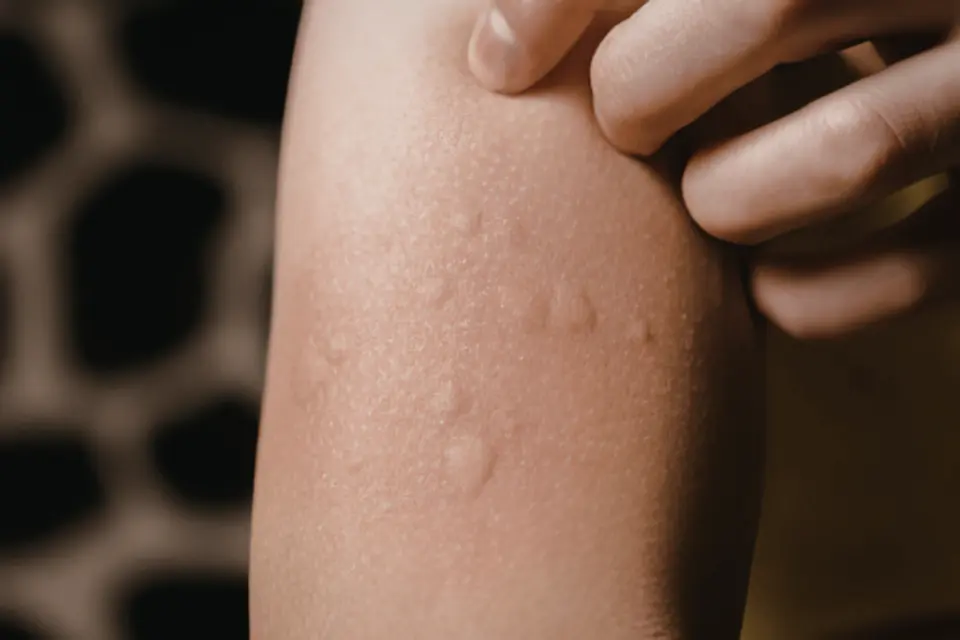 What Do Hives Look Like? A Visual Guide to Common Hive Patterns