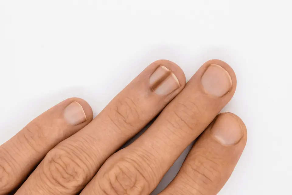 Dark Line on Nail: Harmless Streak or Cancer Warning Sign?