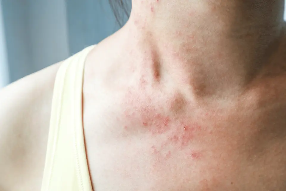 Bacterial Skin Rash vs. Sun Rash: How to Tell the Difference
