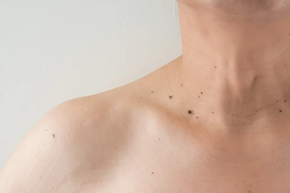 Can You Remove a Skin Tag Overnight? What Actually Works