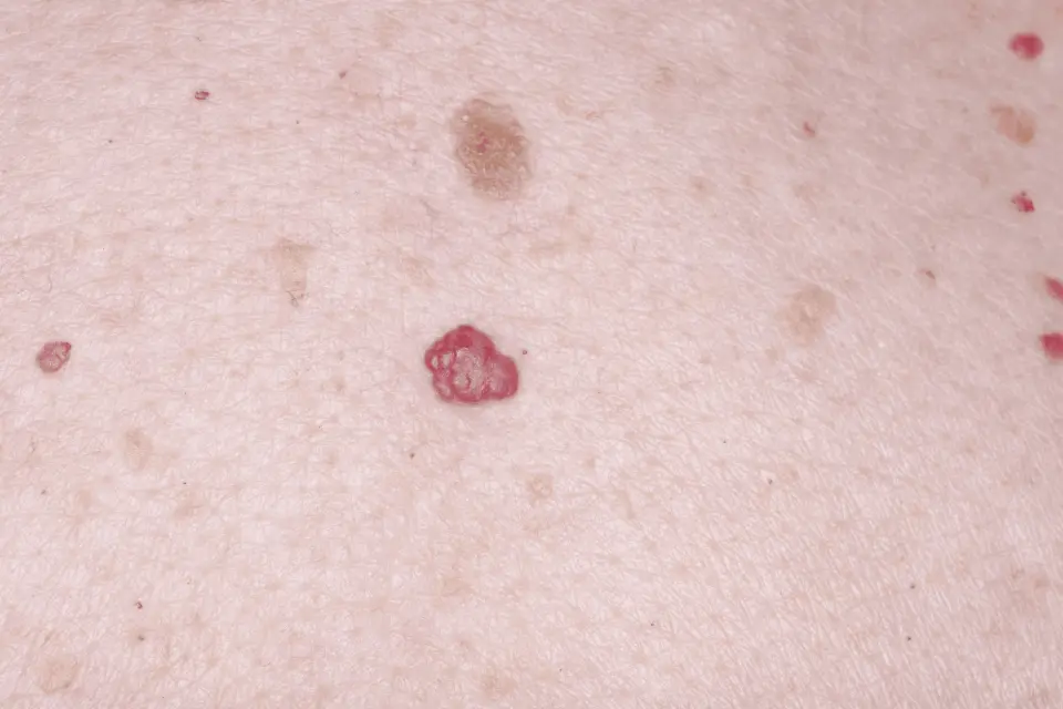 Red Moles on Skin: Cherry Angiomas and When to Be Concerned