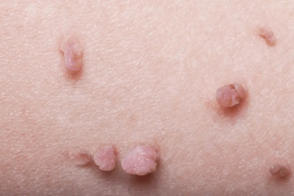 Removing Skin Tags at Home: What's Safe and What to Avoid