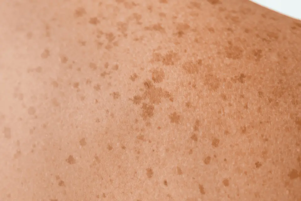 Sunspots on Skin: How to Identify, Prevent, and Treat Them