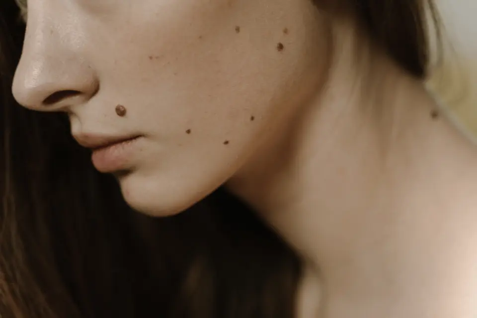 Moles on Your Face: When a Cosmetic Concern Becomes a Health One