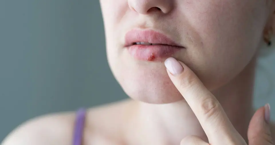 Herpes vs Pimple: Key Visual and Symptom Differences (2026)
