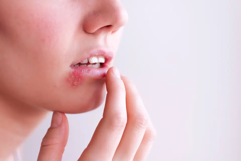 5 Common and Serious Side Effects of Abreva (2026)