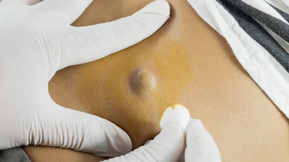 Can Urgent Care Drain a Cyst?
