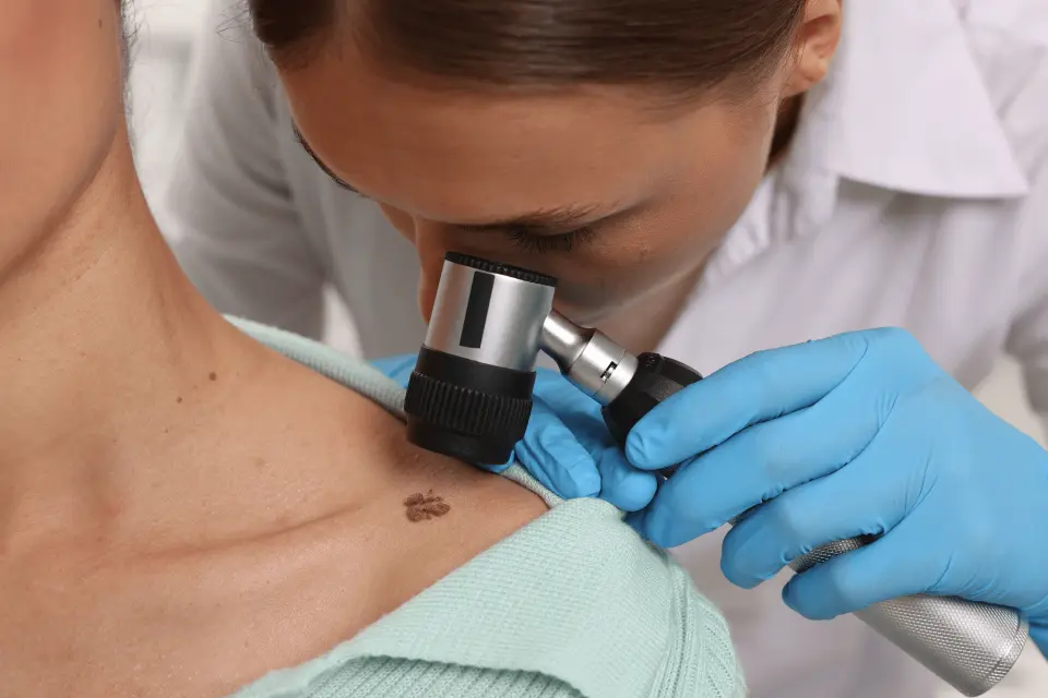 Intradermal Nevus: When a Raised Mole Is Harmless and When to Monitor