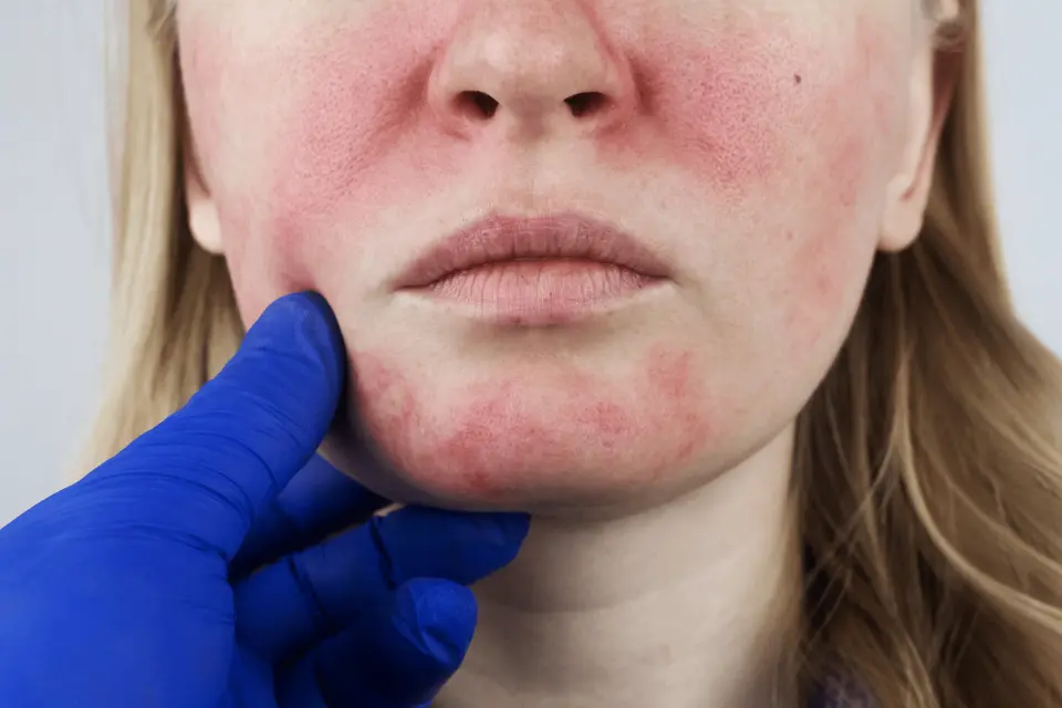 Psoriasis vs. Rosacea: Key Differences and How Sun Affects Both