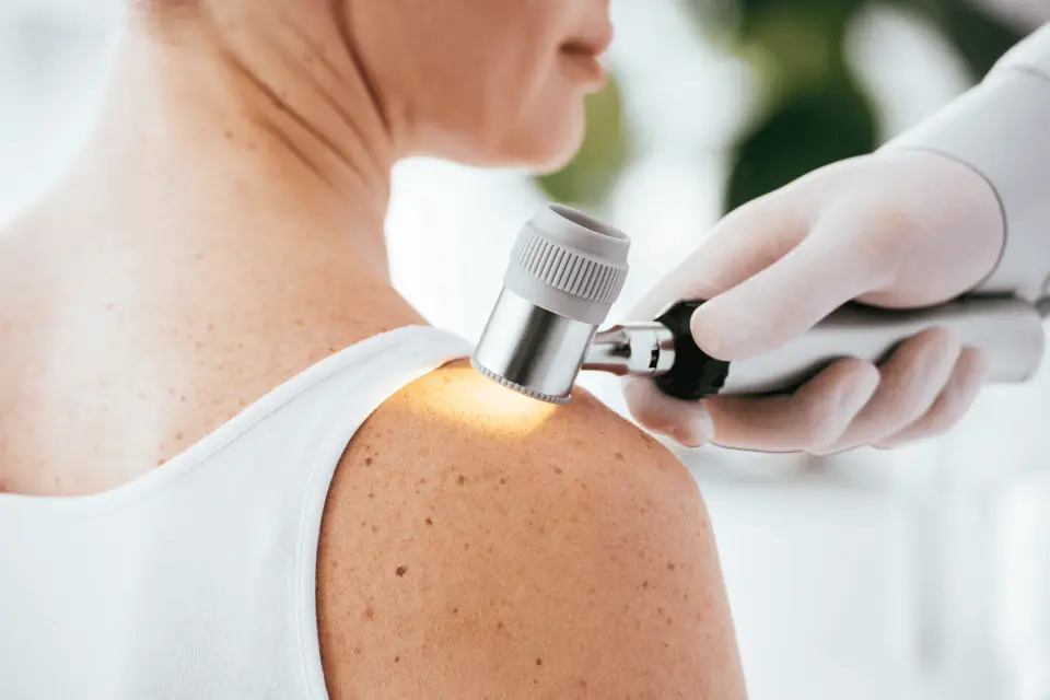 Signs of Melanoma: The ABCDE Rule and Beyond