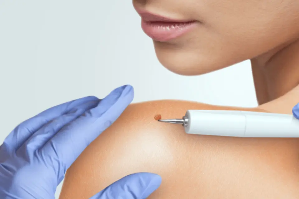 Mole Removal: Methods, Costs, and What the Procedure Involves