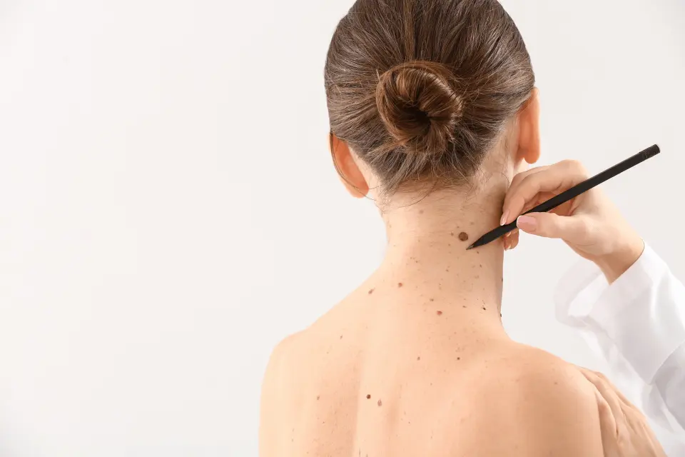 Mole Removal Cost: What to Expect With and Without Insurance