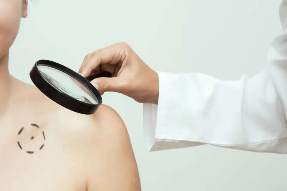 Skin Cancer Treatment: Your Options from Surgery to Immunotherapy