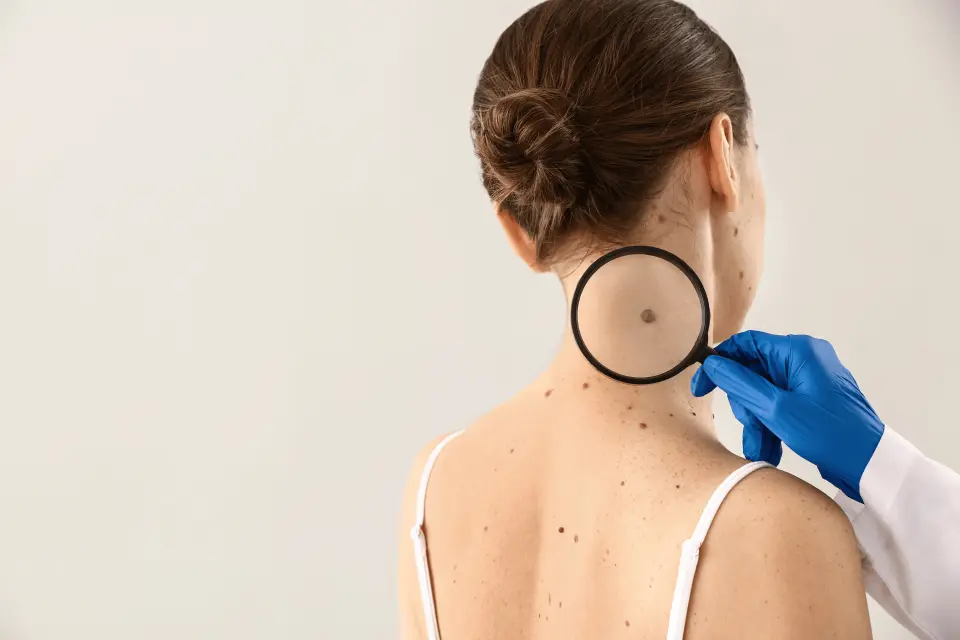 Nodular Melanoma: The Fast-Growing Skin Cancer You Need to Know About