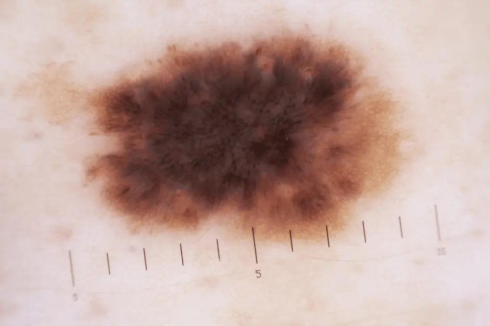 Stage 1 Melanoma: Diagnosis, Treatment, and Survival Rates